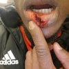 Photo : Ex-Flying Eagle Gero Suffers Nasty Injury In Europa League (Viewers Discretion)